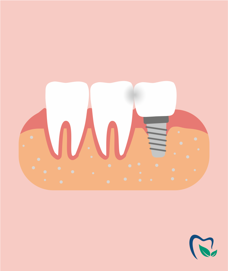 Почему имплантат давит на соседний зуб?